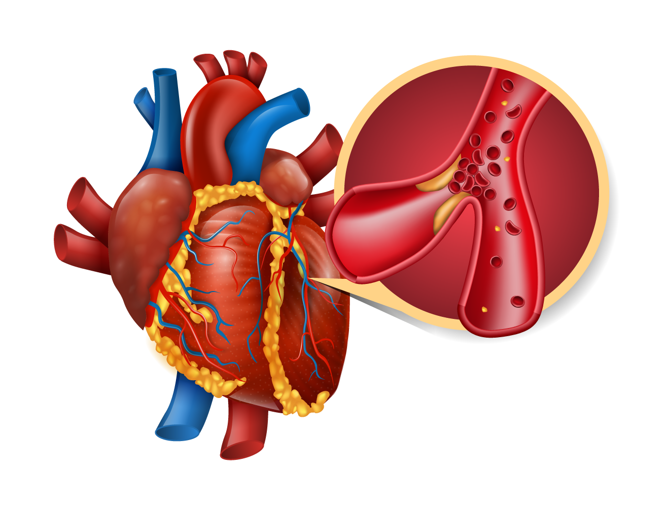 قسطرة القلب - جراحة القلب